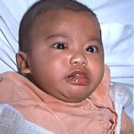 Infant with pertussis, second in a sequence.
