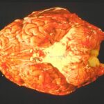 Brain of a person who died from pneumococcal brain infection.