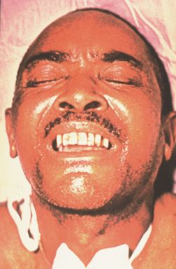 An adult patient's facial symptoms of tetanus.